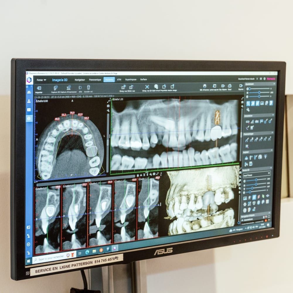 Implants dentaires à La Prairie