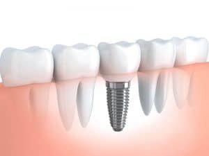 Dent avec un implant dentaire