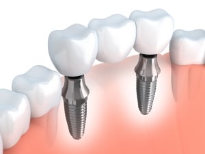 Implants dentaires à place de prothèses partielles