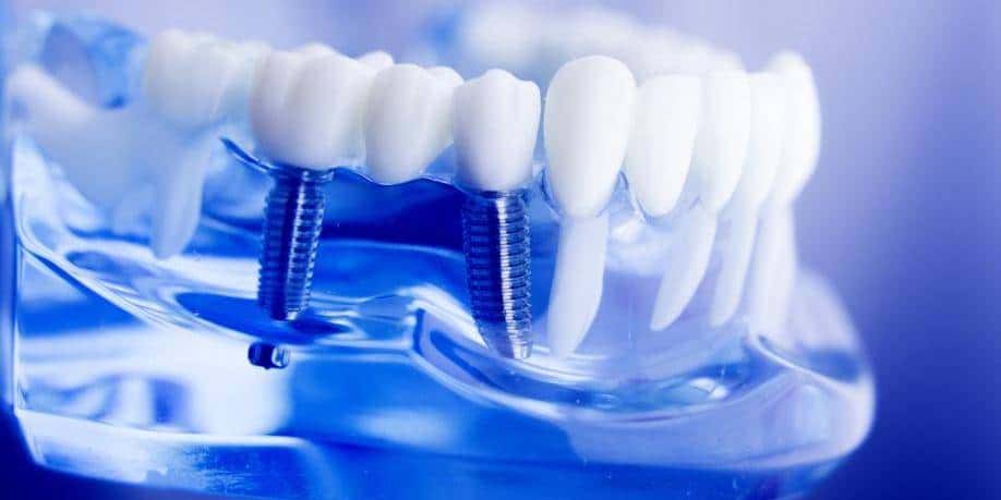 La pose d’implants dentaires est-elle douloureuse? | Centre dentaire St-Onge